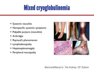 Mixed cryoglobulinemia
§ Systemic vasculitis
§ Nonspecific systemic symptoms
§ Palpable purpura (vasculitis)
§ Arthralgia
§ Raynaud’s phenomenon
§ Lymphadenopathy
§ Hepatosplenomegaly
§ Peripheral neuropathy
Brenner&Rector’s: The Kidney 10th Edition
 