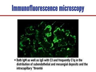 Immunofluorescence microscopy
§ Both IgM as well as IgG with C3 and frequently C1q in the
distribution of subendothelial and mesangial deposits and the
intracapillary “thrombi
 