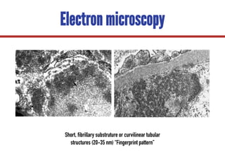 Electron microscopy
Short, fibrillary substruture or curvilinear tubular
structures (20-35 nm) “Fingerprint pattern”
 