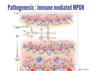 N Engl J Med 2012;366:1119-31.
Pathogenesis : immune mediated MPGN
 