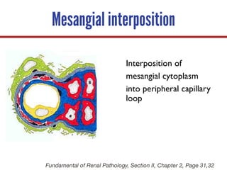 Mesangial interposition
Interposition of
mesangial cytoplasm
into peripheral capillary
loop
Fundamental of Renal Pathology, Section II, Chapter 2, Page 31,32
 