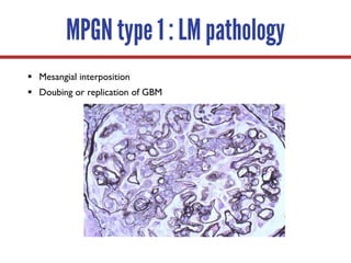 MPGN type 1 : LM pathology
§ Mesangial interposition
§ Doubing or replication of GBM
 