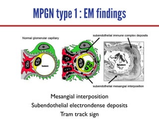 MPGN type 1 : EM findings
Mesangial interposition
Subendothelial electrondense deposits
Tram track sign
 