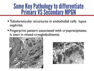 § Tubuloreticular structures in endothelial cells lupus
nephritis
§ Fingerprint pattern associated with cryoprecipitates
is seen in mixed cryoglobulinemia
Some Key Pathology to differentiate
Primary VS Secondary MPGN
 
