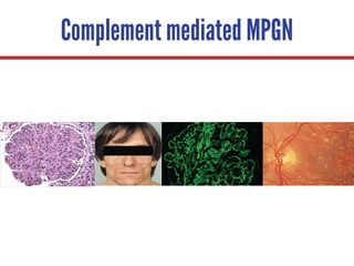 Complement mediated MPGN
 