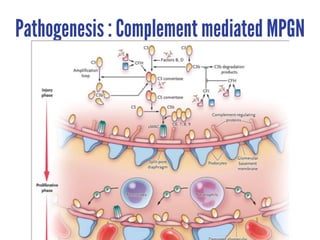 Pathogenesis : Complement mediated MPGN
 