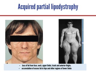 Acquired partial lipodystrophy
- loss of fat from face, neck, upper limbs, trunk and anterior thighs.
- accumulation of excess fat in hips and other regions of lower limbs
 
