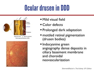 Ocular drusen in DDD
§ Mild visual field
§ Color defects
§ Prolonged dark adaptation
§ mottled retinal pigmentation
(drusen bodies)
§ Indocyanine green
angiography dense deposits in
ciliary basement membrane
and choroidal
neovascularization
Brenner&Rector’s: The Kidney 10th Edition
 