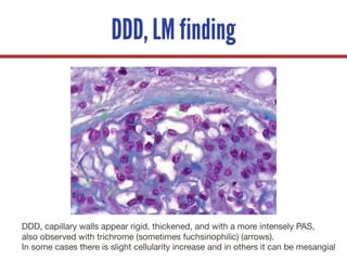 DDD, LM finding
DDD, capillary walls appear rigid, thickened, and with a more intensely PAS,
also observed with trichrome (sometimes fuchsinophilic) (arrows).
In some cases there is slight cellularity increase and in others it can be mesangial
 