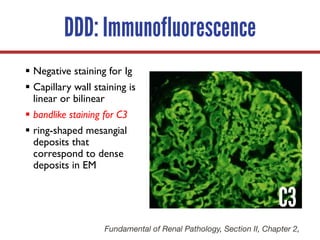 C3
§ Negative staining for Ig
§ Capillary wall staining is
linear or bilinear
§ bandlike staining for C3
§ ring-shaped mesangial
deposits that
correspond to dense
deposits in EM
C3DDD: Immunofluorescence
Fundamental of Renal Pathology, Section II, Chapter 2,
 