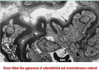 Dense ribbon like appearance of subendothelial and inramembranous material
 