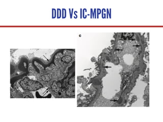 DDD Vs IC-MPGN
 