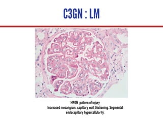 C3GN : LM
MPGN pattern of injury
Increased mesangium, capillary wall thickening, Segmental
endocapillary hypercellularity.
 