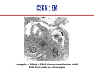 C3GN : EM
complex pattern of thickening of GBM with intramembranous electron-dense material.
Similar deposits are also seen in the mesangium
 