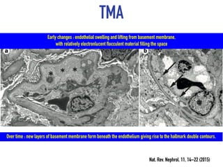 TMA
Nat. Rev. Nephrol. 11, 14–22 (2015)
Early changes : endothelial swelling and lifting from basement membrane,
with relatively electronlucent flocculent material filling the space
Over time : new layers of basement membrane form beneath the endothelium giving rise to the hallmark double contours.
 