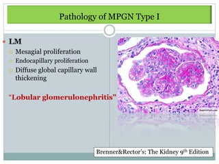 Pathology of MPGN Type I

 LM
    Mesagial proliferation
    Endocapillary proliferation
    Diffuse global capillary wall
     thickening

 “Lobular glomerulonephritis”




                                   Brenner&Rector’s: The Kidney 9th Edition
 