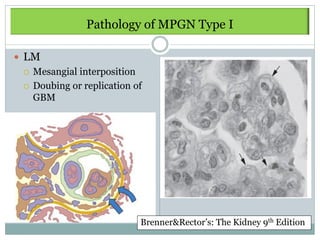 Pathology of MPGN Type I

 LM
    Mesangial interposition
    Doubing or replication of
     GBM




                             Brenner&Rector’s: The Kidney 9th Edition
 