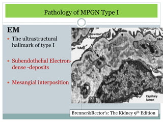 Pathology of MPGN Type I

EM
 The ultrastructural
  hallmark of type I

 Subendothelial Electron-
  dense -deposits

 Mesangial interposition




                            Brenner&Rector’s: The Kidney 9th Edition
 