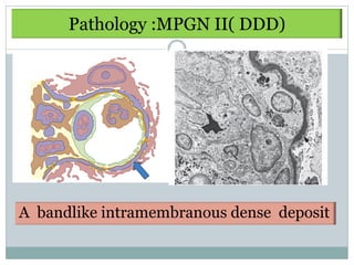 Pathology :MPGN II( DDD)




A bandlike intramembranous dense deposit
 