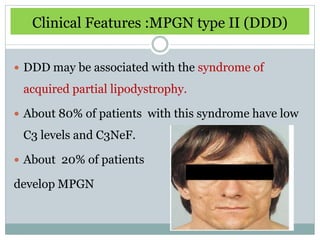 Clinical Features :MPGN type II (DDD)

 DDD may be associated with the syndrome of

 acquired partial lipodystrophy.

 About 80% of patients with this syndrome have low

 C3 levels and C3NeF.

 About 20% of patients

develop MPGN
 