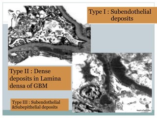 Type I : Subendothelial
                                     deposits




Type II : Dense
deposits in Lamina
densa of GBM

Type III : Subendothelial
&Subepithelial deposits
 