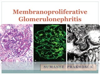 Membranoproliferative
 Glomerulonephritis




        SUMANEE PRAKOBSUK
 