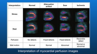 Interpretation of myocardial perfusion images
 