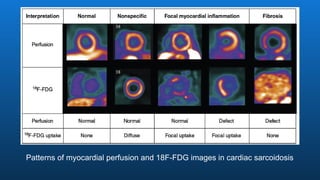 Patterns of myocardial perfusion and 18F-FDG images in cardiac sarcoidosis
 