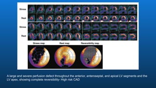 A large and severe perfusion defect throughout the anterior, anteroseptal, and apical LV segments and the
LV apex, showing complete reversibility- High risk CAD
 
