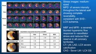 Stress images: medium-
sized
MPD of severe intensity
throughout the lateral wall
showing complete
reversibility,
consistent with SVD -
LCX ischemia.
MBF and MFR - a severely
blunted hyperemic flow
response to vasodilator
stress and reduced flow
reserve in all coronary
territories.
CT- LM, LAD, LCX severe
calcification
CAG - Sever LM / LCX DS
 