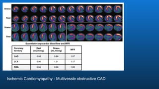 Ischemic Cardiomyopathy - Multivessle obstructive CAD
 