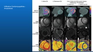 Infiltrative Cardiomyopathies -
Amyloidosis
 