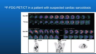 18
F-FDG PET/CT in a patient with suspected cardiac sarcoidosis
 