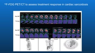 18
F-FDG PET/CT to assess treatment response in cardiac sarcoidosis
 