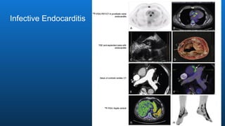 Infective Endocarditis
 