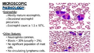 MICROSCOPIC
PATHOLOGY:
Peripheral Blood:
•Eosinophilia:
oMostly mature eosinophils.
oOccasional eosinophil
precursors.
oEosinophil count ≥ 1.5 x 10⁹/L.
•Other features:
• Neutrophilia common.
• Blasts < 20% (usually > 2%).
• No significant population of mast
cells.
• No circulating lymphoma cells.
 