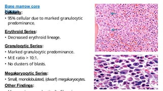 Bone marrow core
biopsy:
Cellularity:
• 95% cellular due to marked granulocytic
predominance.
Erythroid Series:
• Decreased erythroid lineage.
Granulocytic Series:
• Marked granulocytic predominance.
• M:E ratio > 10:1.
• No clusters of blasts.
Megakaryocytic Series:
• Small, monolobulated, (dwarf) megakaryocytes.
Other Findings:
 