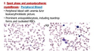 2. Spent phase and post-polycythemic
myelofibrosis: Peripheral Blood:
• Peripheral blood with anemia &/or
leukoerythroblastic picture.
• Prominent anisopoikilocytosis, including teardrop
forms and nucleated RBCs.
• Immature granulocytic cells but no significant
dysplastic cells.
 