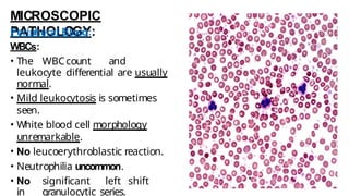 MICROSCOPIC
PATHOLOGY:
Peripheral Blood:
WBCs:
• The WBCcount and
leukocyte differential are usually
normal.
• Mild leukocytosis is sometimes
seen.
• White blood cell morphology
unremarkable.
• No leucoerythroblastic reaction.
• Neutrophilia uncommon.
• No significant left shift
in granulocytic series.
 