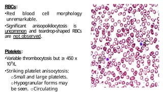 RBCs:
•Red blood cell morphology
unremarkable.
•Significant anisopoikilocytosis is
uncommon and teardrop-shaped RBCs
are not observed.
Platelets:
•Variable thrombocytosis but ≥ 450 x
10⁹/L.
•Striking platelet anisocytosis:
oSmall and large platelets.
oHypogranular forms may
be seen. oCirculating
 