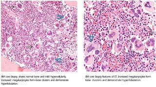 BM core biopsy shows normal bone and mild hypercellularity.
Increased megakaryocytes form loose clusters and demonstrate
hyperlobulation.
BM core biopsy features of ET. Increased megakaryocytes form
loose clusters and demonstrate hyperlobulation.
 