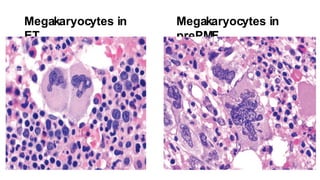 Megakaryocytes in
ET
Megakaryocytes in
prePMF
 