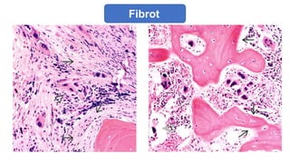 Fibrot
ic
 