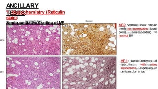 MF-0: Scattered linear reticulin
with no intersections (cross-
overs) corresponding to
normal BM
MF-1: Loose network of
reticulin with many
intersections, especially in
perivascular areas
ANCILLARY
TESTS:
1. Histochemistry (Reticulin
stain):
Semiquantitative Grading of MF
 