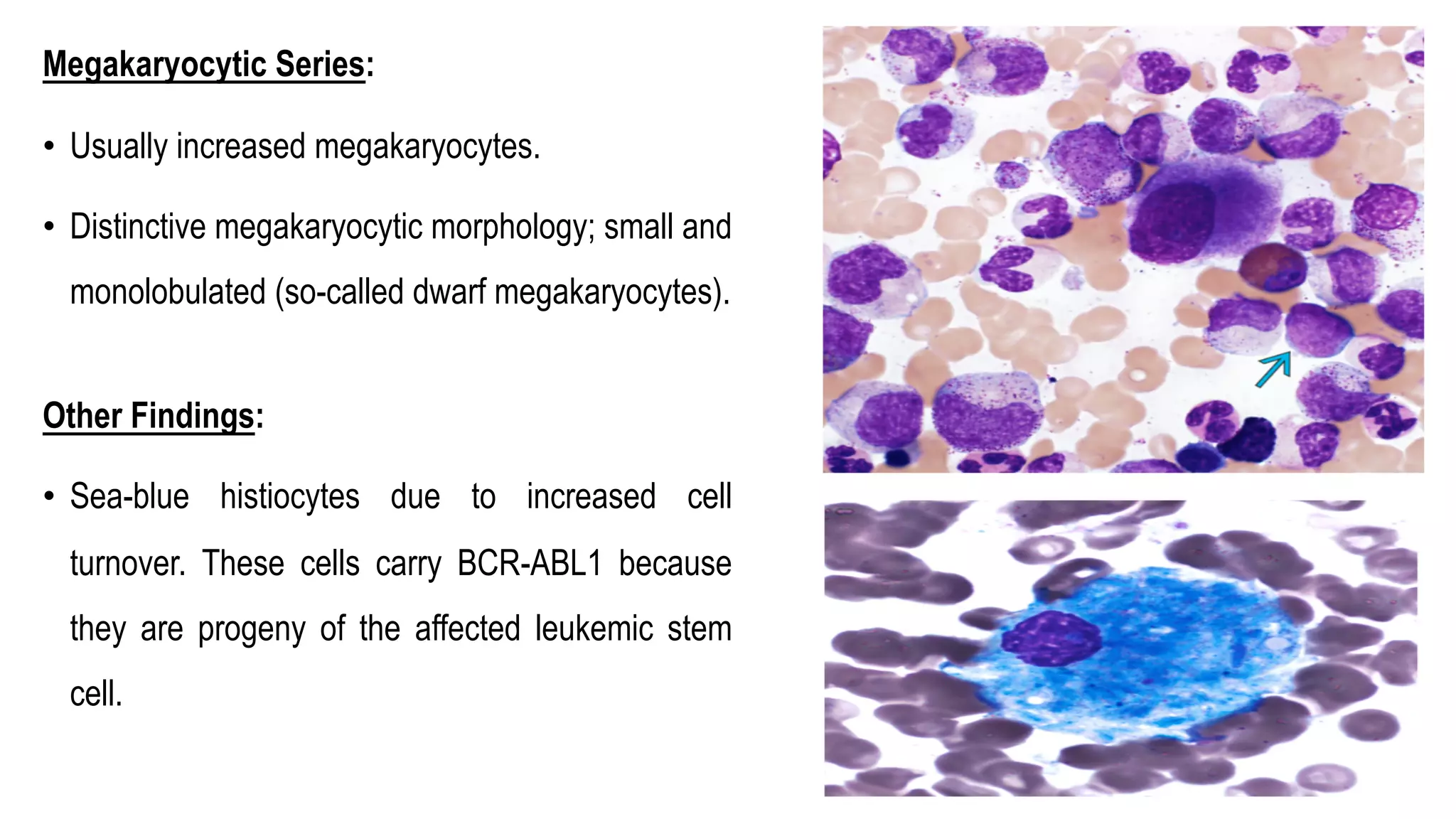 Megakaryocytic Series:
• Usually increased megakaryocytes.
• Distinctive megakaryocytic morphology; small and
monolobulated (so-called dwarf megakaryocytes).
Other Findings:
• Sea-blue histiocytes due to increased cell
turnover. These cells carry BCR-ABL1 because
they are progeny of the affected leukemic stem
cell.
 