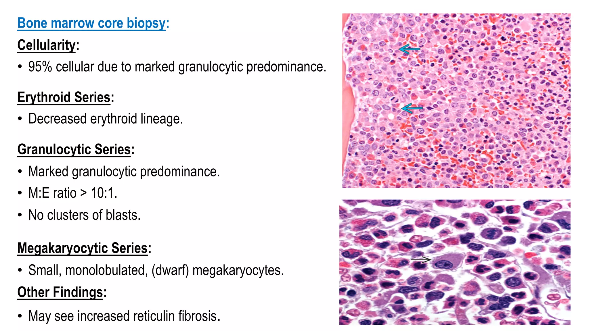 Bone marrow core biopsy:
Cellularity:
• 95% cellular due to marked granulocytic predominance.
Erythroid Series:
• Decreased erythroid lineage.
Granulocytic Series:
• Marked granulocytic predominance.
• M:E ratio > 10:1.
• No clusters of blasts.
Megakaryocytic Series:
• Small, monolobulated, (dwarf) megakaryocytes.
Other Findings:
• May see increased reticulin fibrosis.
 