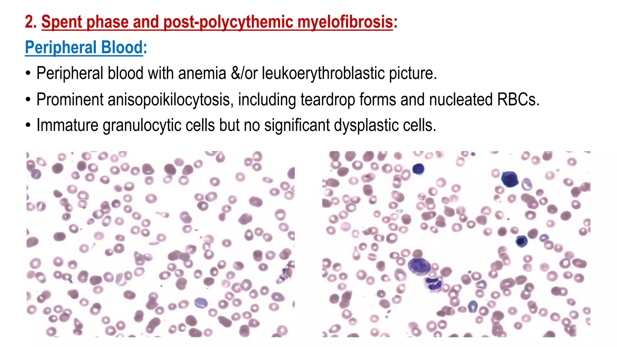2. Spent phase and post-polycythemic myelofibrosis:
Peripheral Blood:
• Peripheral blood with anemia &/or leukoerythroblastic picture.
• Prominent anisopoikilocytosis, including teardrop forms and nucleated RBCs.
• Immature granulocytic cells but no significant dysplastic cells.
 