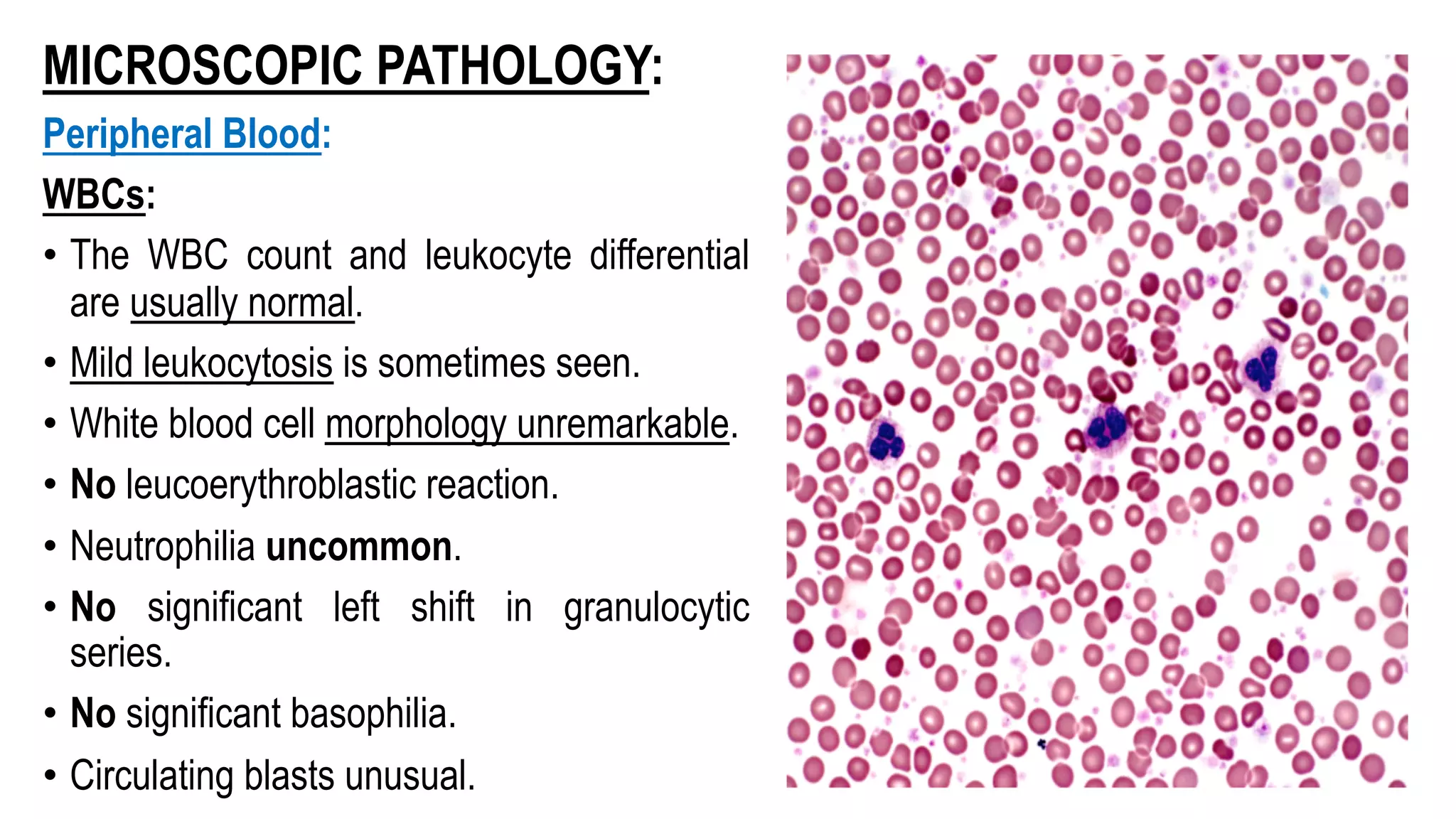 MICROSCOPIC PATHOLOGY:
Peripheral Blood:
WBCs:
• The WBC count and leukocyte differential
are usually normal.
• Mild leukocytosis is sometimes seen.
• White blood cell morphology unremarkable.
• No leucoerythroblastic reaction.
• Neutrophilia uncommon.
• No significant left shift in granulocytic
series.
• No significant basophilia.
• Circulating blasts unusual.
 
