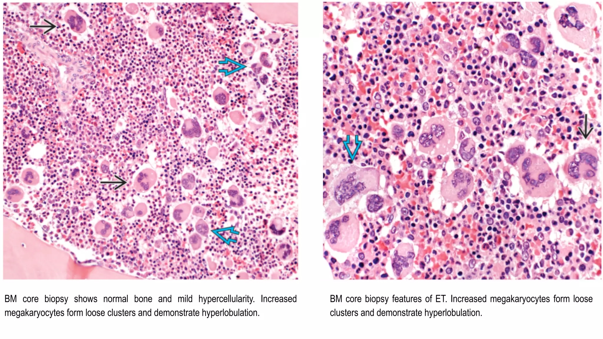 BM core biopsy shows normal bone and mild hypercellularity. Increased
megakaryocytes form loose clusters and demonstrate hyperlobulation.
BM core biopsy features of ET. Increased megakaryocytes form loose
clusters and demonstrate hyperlobulation.
 