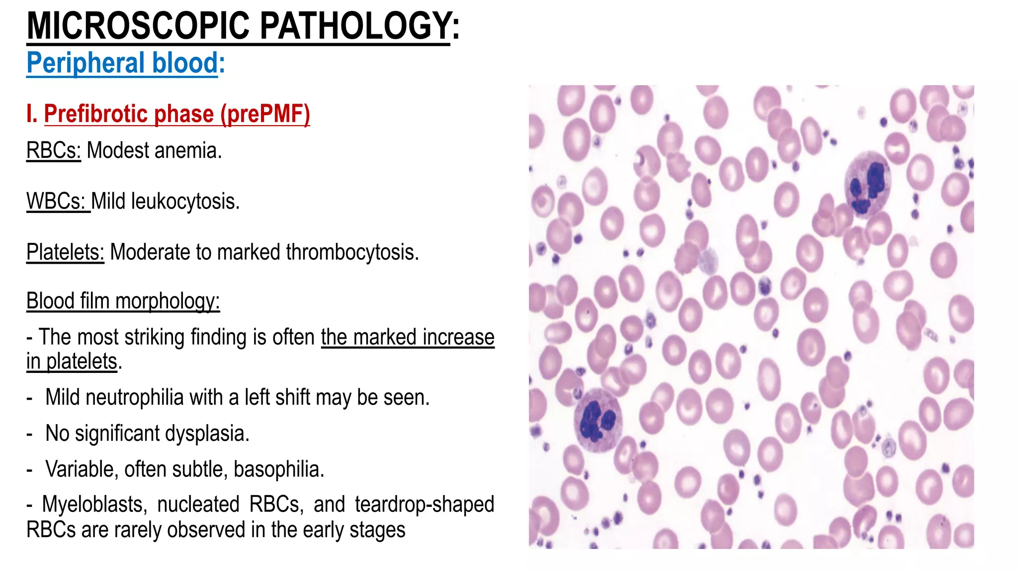 MICROSCOPIC PATHOLOGY:
Peripheral blood:
I. Prefibrotic phase (prePMF)
RBCs: Modest anemia.
WBCs: Mild leukocytosis.
Platelets: Moderate to marked thrombocytosis.
Blood film morphology:
- The most striking finding is often the marked increase
in platelets.
- Mild neutrophilia with a left shift may be seen.
- No significant dysplasia.
- Variable, often subtle, basophilia.
- Myeloblasts, nucleated RBCs, and teardrop-shaped
RBCs are rarely observed in the early stages
 